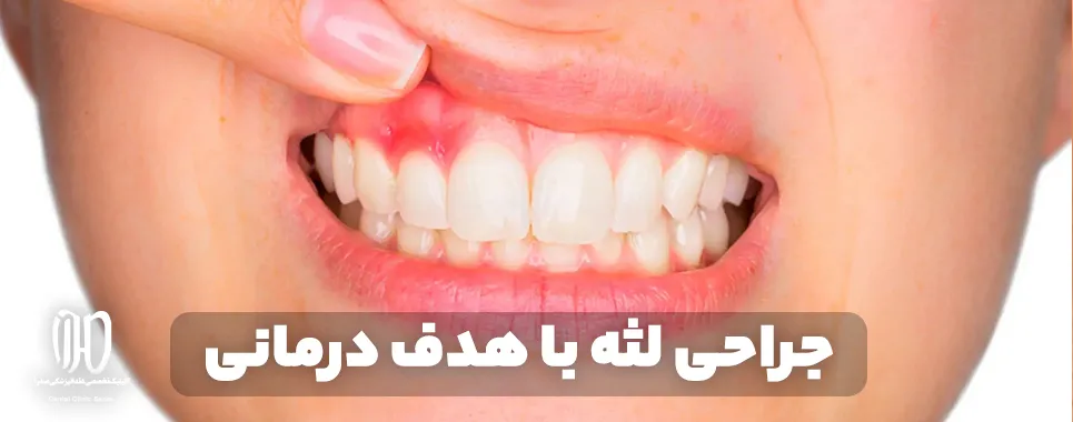 جراحی لثه با هدف درمانی