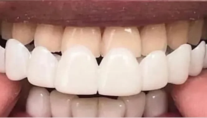 کامپوزیت زیبایی دیجیتال