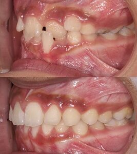 نمونه کار ارتودنسی کلینیک دندانپزشکی صدرا