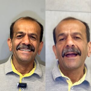 نمونه کار ایمپلنت کلینیک دندانپزشکی صدرا