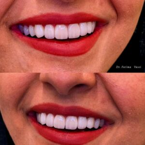 طراحی لبخند لمینت سرامیکی کلینیک دندانپزشکی صدرا