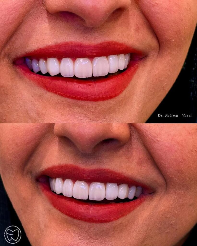 طراحی لبخند لمینت سرامیکی کلینیک دندانپزشکی صدرا