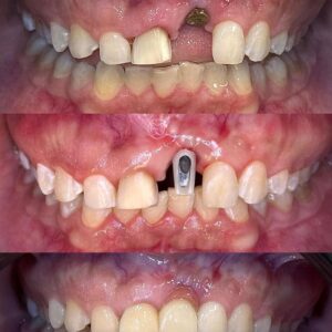 نمونه کار لمینت سرامیکی بر پایه ایمپلنت کلینیک دندانپزشکی صدرا
