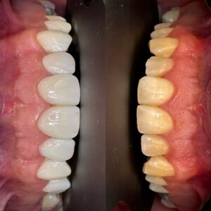 نمونه کار کامپوزیت در کلینیک دندانپزشکی صدرا