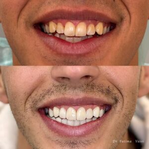 نمونه کار کامپوزیت در کلینیک دندانپزشکی صدرا