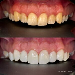 نمونه کار کامپوزیت در کلینیک دندانپزشکی صدرا