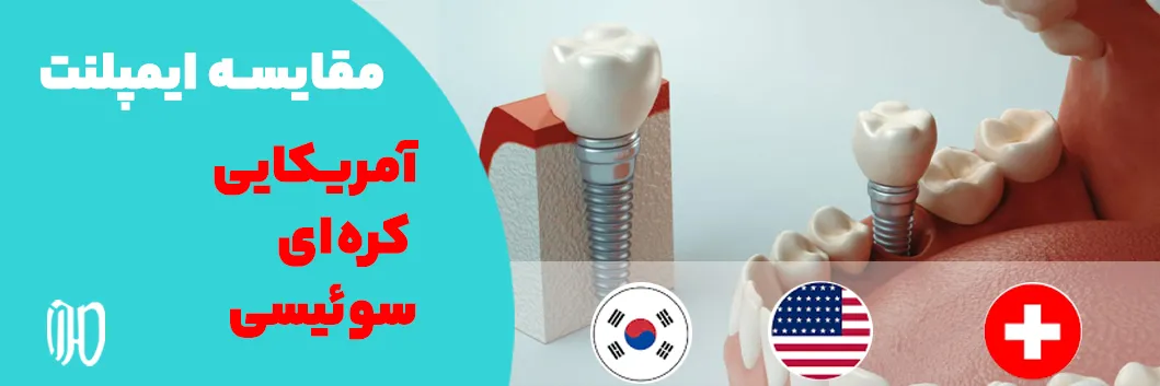 مقایسه ایمپلنت آمریکایی، کره‌ای و سوئیسی
