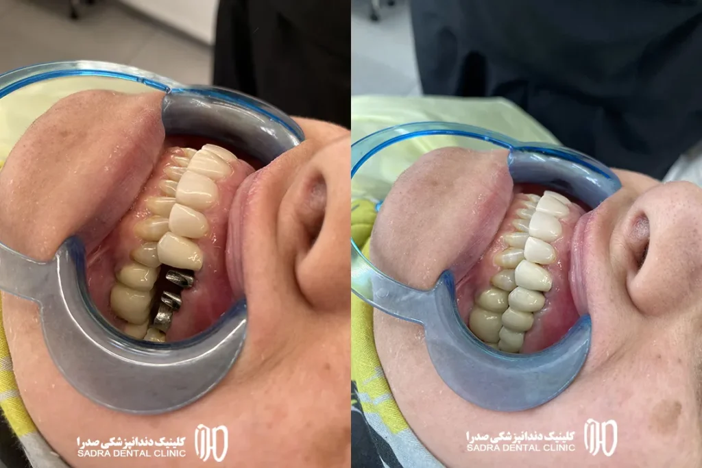 بهترین متخصص ایمپلنت شیراز