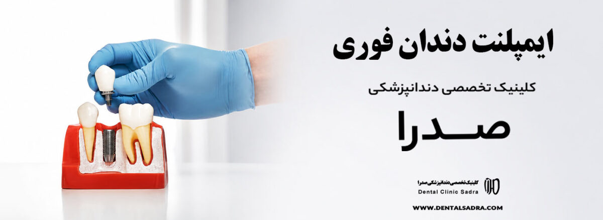 ایمپلنت دندان فوری