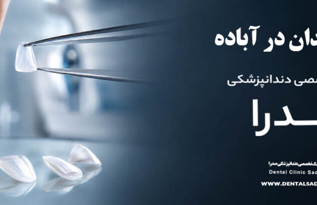 لمینت دندان در آباده | متخصص لمینت در آباده