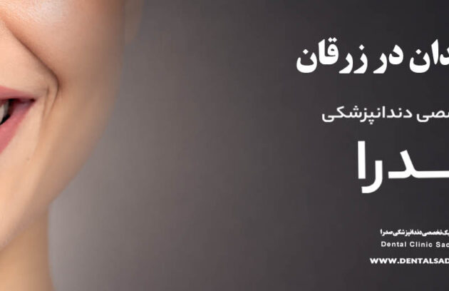 لمینت دندان در زرقان | متخصص لمینت در زرقان