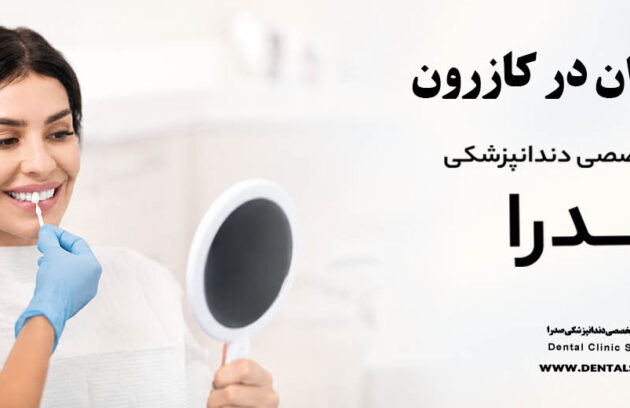 لمینت دندان در کازرون | متخصص لمینت در کازرون